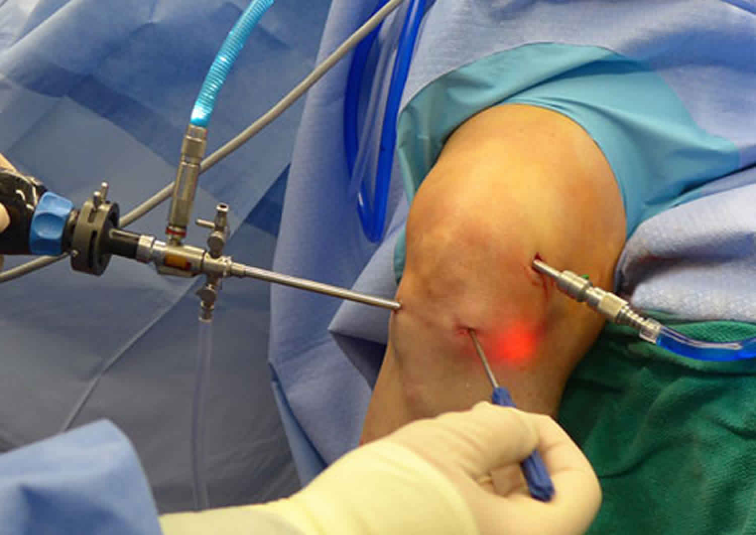 Home Vaibhavhospitals   Knee Arthroscopy 2 